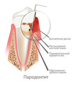 пародонтит