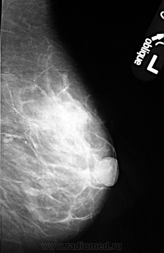 Микрокальцинаты. Маммограмма микрокальцинаты.