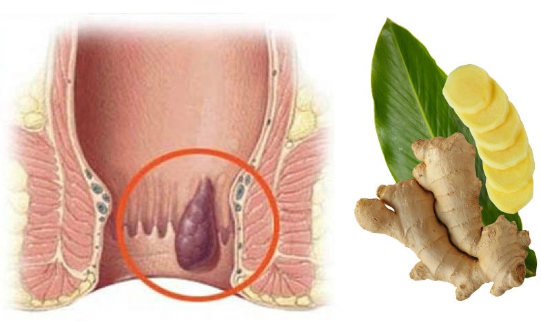как избавится от геморроя с имбирем