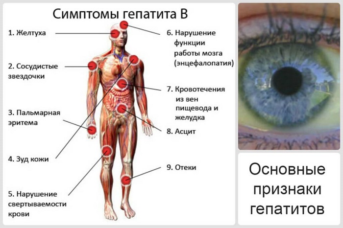 Симптомы гепатита В