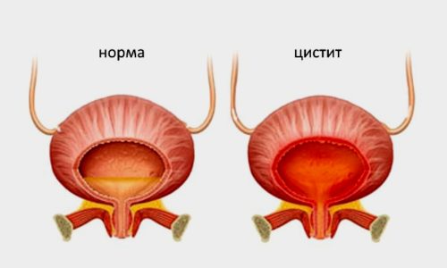 Кандиозный цистит - заболевание стенок мочевого пузыря и мочеиспускательного канала