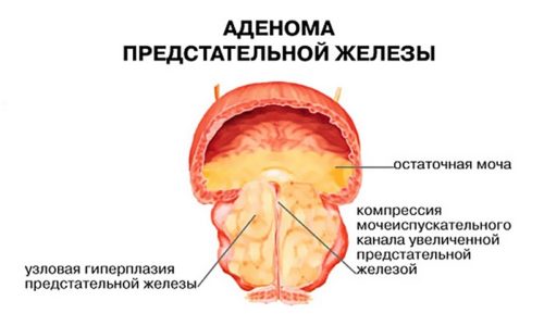 В особенности подвержены появлению песка в почках мужчины, страдающие аденомой предстательной железы, которая провоцирует застой мочи