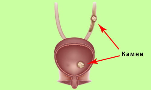 Устранение постлучевого заболевания хирургическим вмешательством показана также при мочекаменной болезни