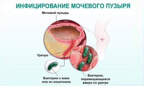 Развитие пиелоцистита у женщин обусловлено особенностями строения мочеполовой системы, т. к. уретра более короткая, поэтому патогенным микроорганизмам легче попасть в организм