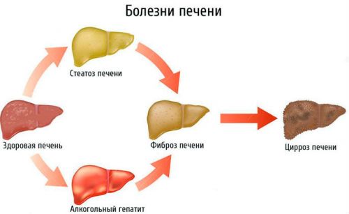 Заболевания печени