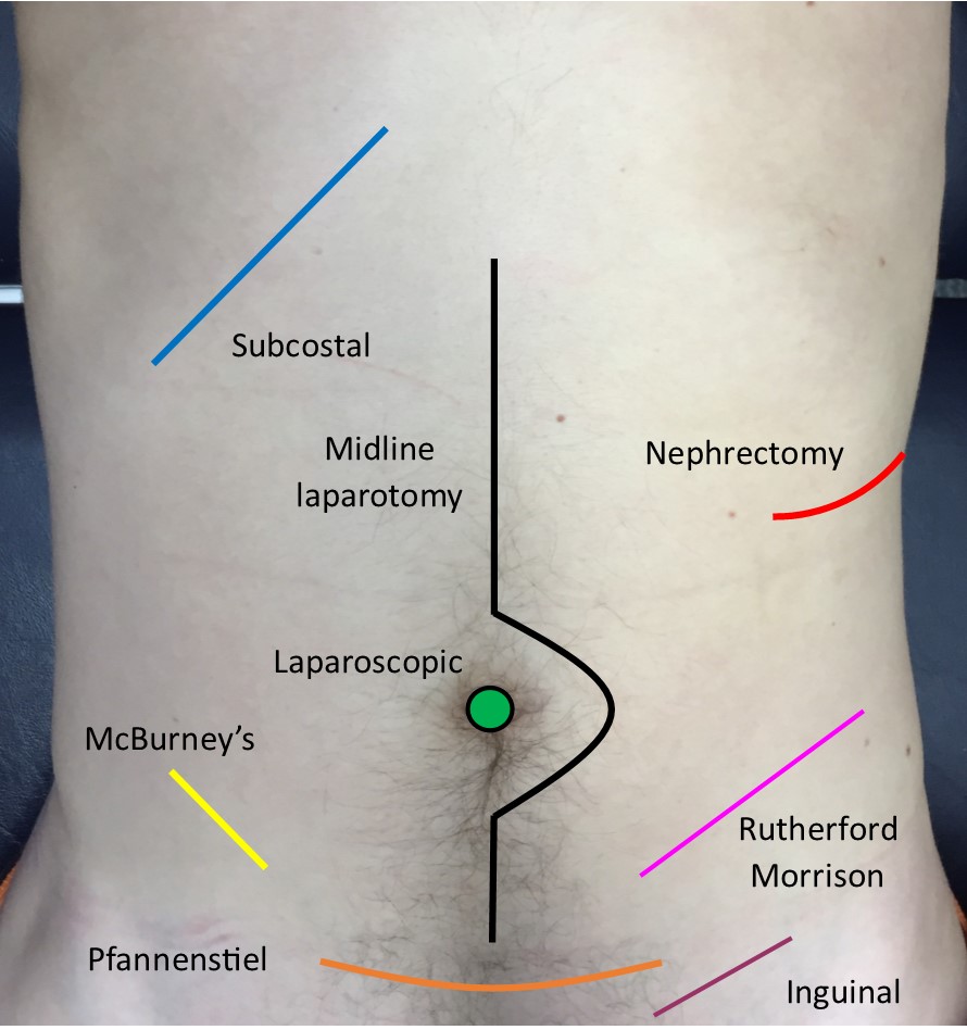 Common abdominal scars.