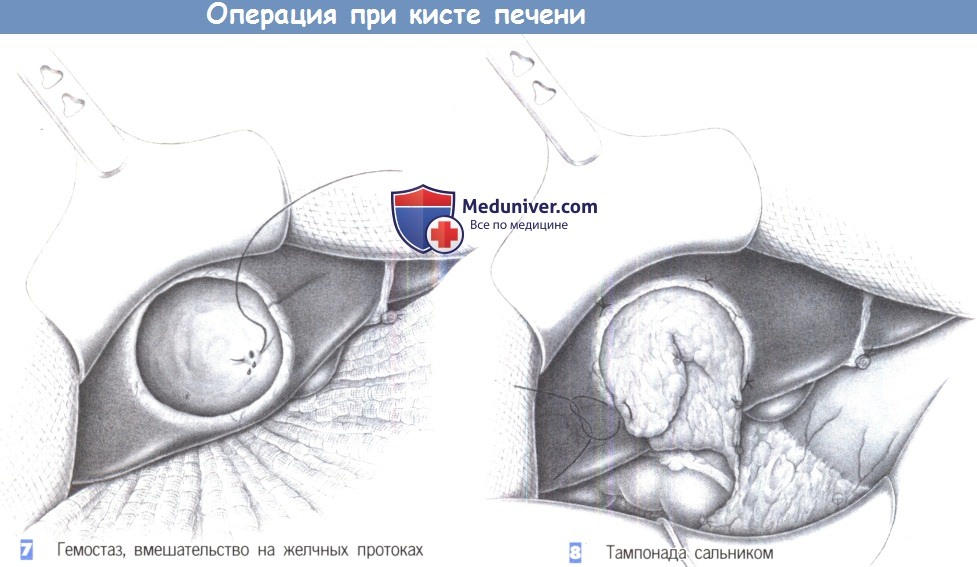 На фото показаны этапы и техника операции при кисте печени. Хирургическое лечение кисты печени чаще всего завершается удачно.