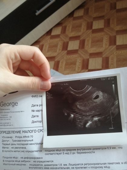 Неделя от зачатия форум. Снимок УЗИ 2-3 недели беременности. Снимок УЗИ на 4 неделе беременности. УЗИ 2 недели беременности фото. Снимок УЗИ на 2 неделе беременности.
