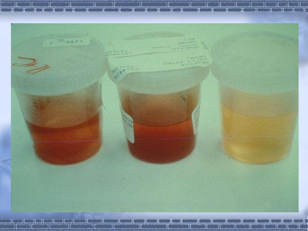 Виды мочи. Какого цвета моча у здорового человека. Моча с примесью крови. Какого цвета моча при беременности.