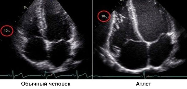 Сонограмма сердца среднестатистического человека и атлета