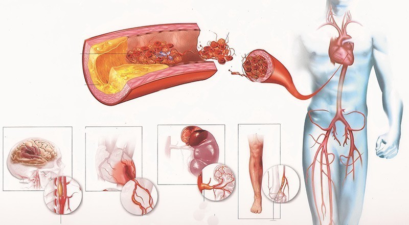 Атеросклеротическое поражение сосудов