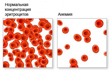 Виды анемии