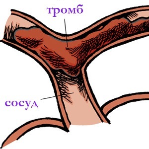 Поражение сосудов крови Характеристика болезни Гессера