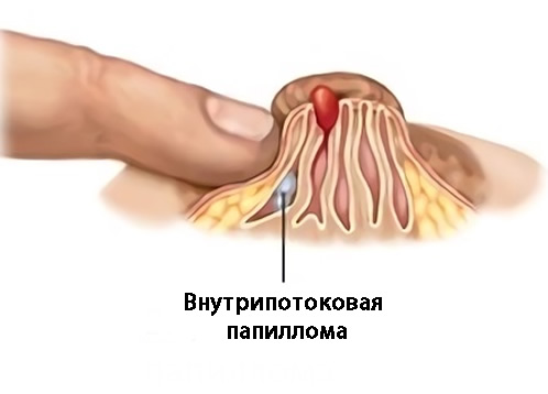 Заболевания, сопровождающиеся выделением крови