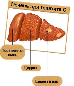 Вирус и вызванное им заболевание