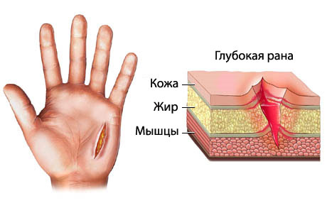 Порез руки