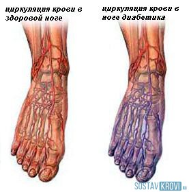 Нормальный кровоток и в ноге диабетика Симптомы