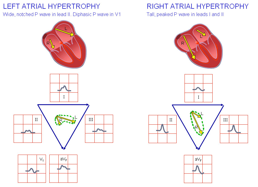 Гипетрофия левого и правого предсердий на ЭКГ