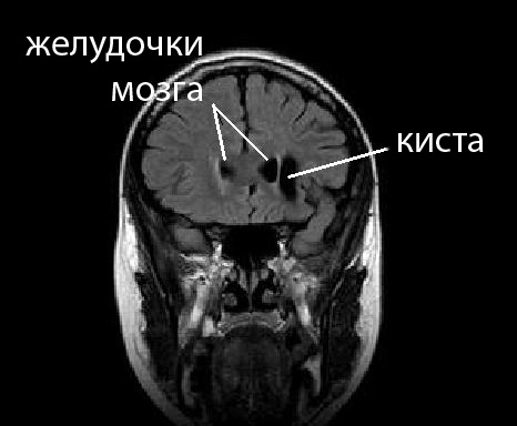 Киста в мозгу. Церебральная арахноидальная киста. Интраселлярная киста головного мозга. Киста головного мкб 10 головного мозга.