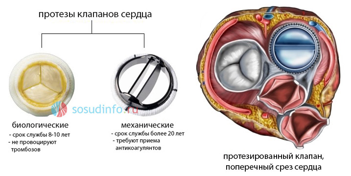 Фиброзное кольцо аортального клапана