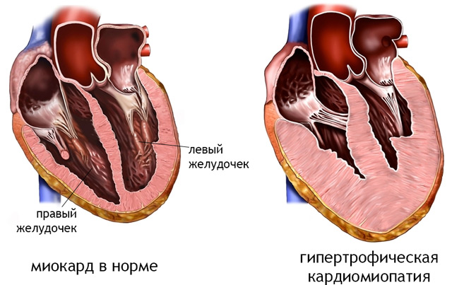 Миокард правого желудочка сердца