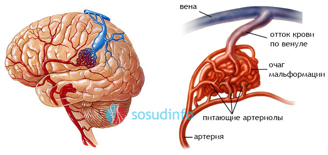 Признаки венозной ангиомы. Венозная ангиома головного мозга правой. Клубок сосудов в голове. Голова медузы венозная ангиома.