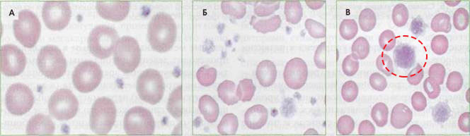 а – тромбоциты в норме (на фоне эритроцитов) б – различные по объему тромбоциты (анизоцитоз) в – огромные макротромбоциты (P-LCR повышен)