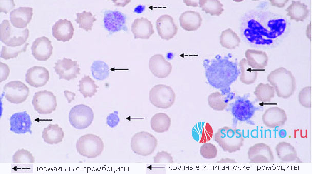 примеры диаграмм содержания тромбоцитов в крови – 1) в норме, 2) при снижении общего числа тромбоцитов и P-LCR в том числе, 3) при росте % P-LCR - наличии большого числа гигантских тромбоцитов