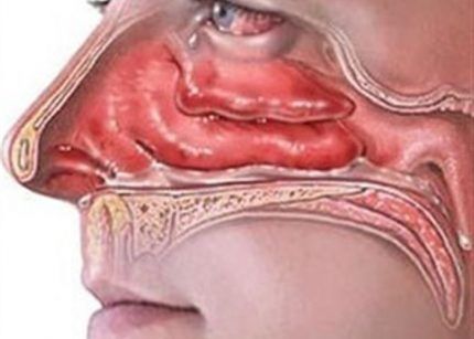 Пыль и живущие в ней микроорганизмы Аллергический ринит