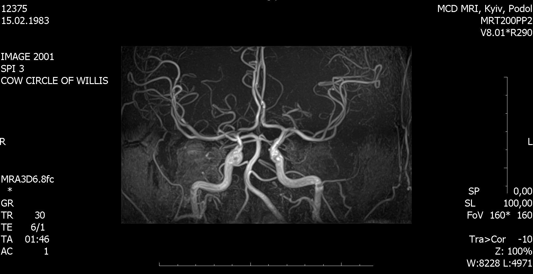 Гипоплазия сегмента v4 позвоночных артерий. V4 сегментов позвоночных артерий. Гипоплазия v4 сегмента левой позвоночной артерии. Сегменты v1 v2 позвоночных артерий. Гипоплазия правой позвоночной артерии сегменты.