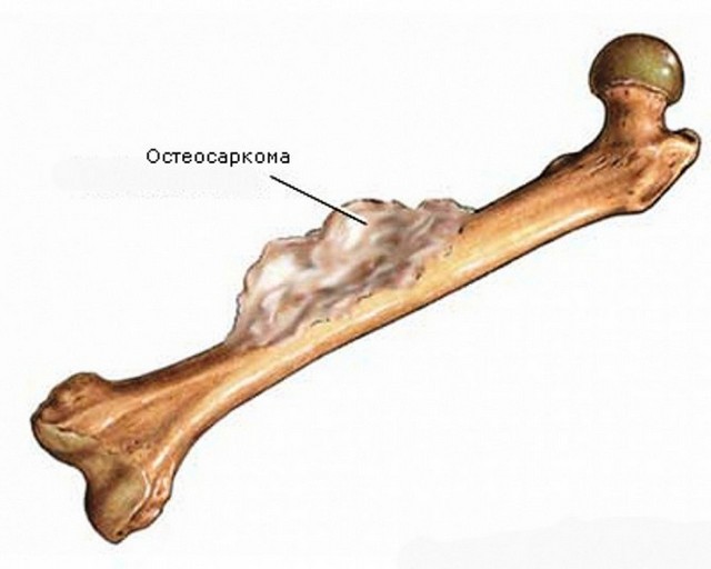 Злокачественная опухоль может серьёзно испортить жизнь человека