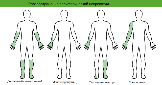 Виды недуга