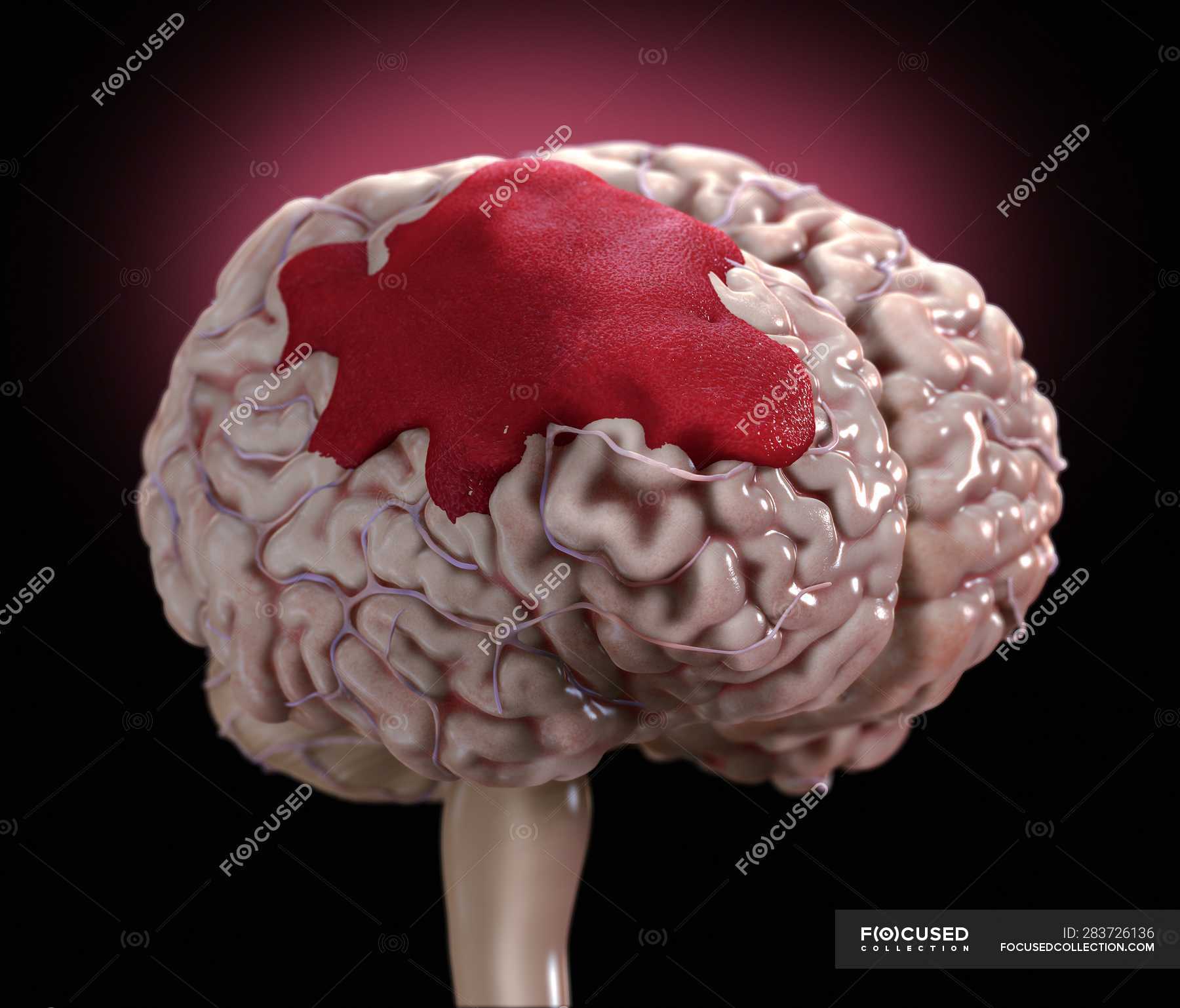 Внутреннее мозговое кровоизлияние