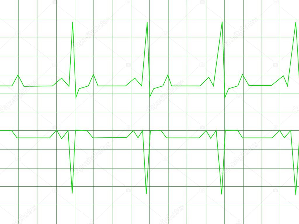 Картинка нормального экг. Нормальный сердечный ритм — Стоковое ...