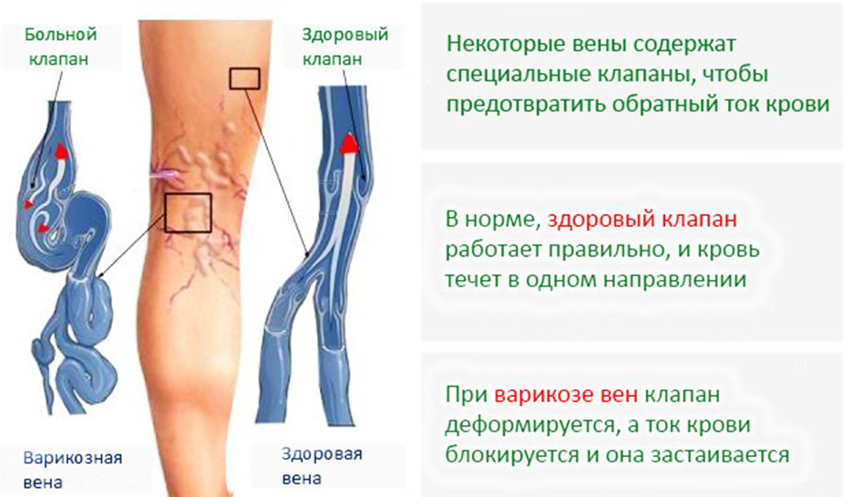 varikoznom-rasshirenii-ven-1.jpg