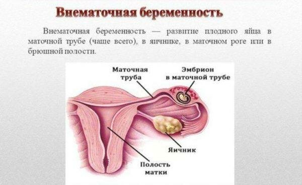 Внематочная беременность может быть причиной сильных болевых ощущений внизу живота