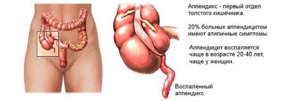 Резкая боль может свидетельствовать о воспалении аппендикса