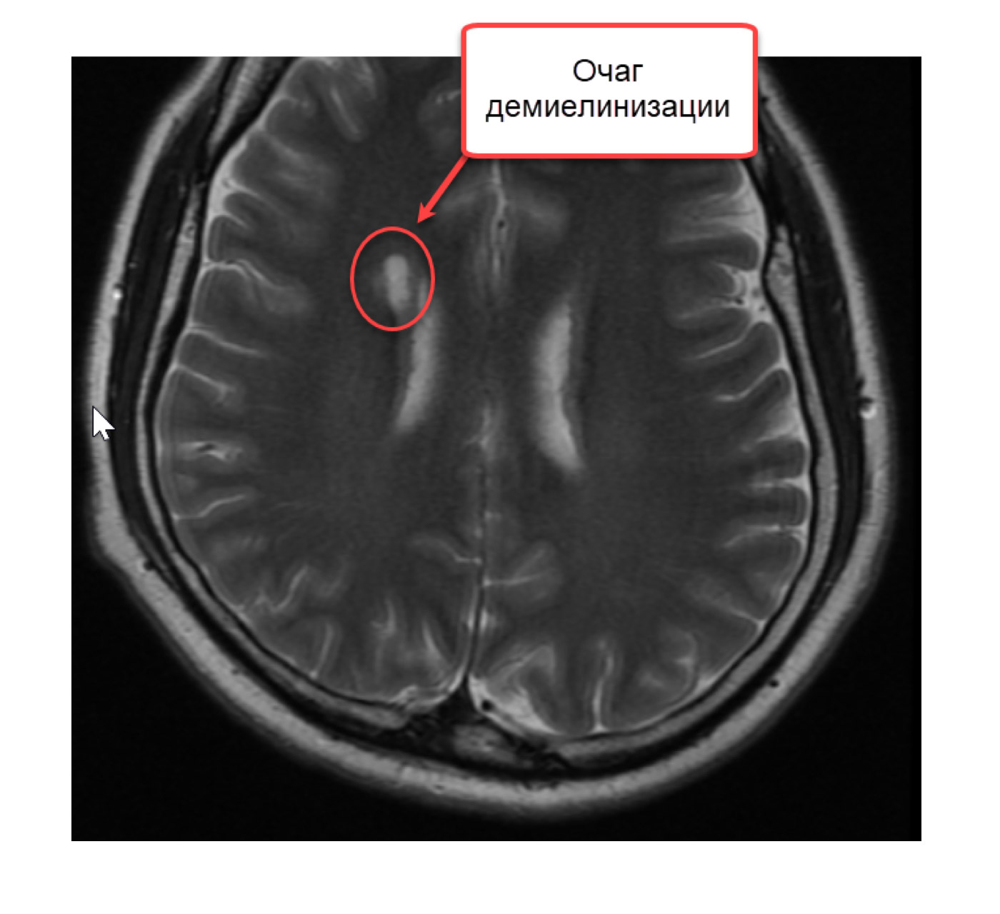 Мрт при рассеянном склерозе. Мрт рассеянный склероз очаги демиелинизации. Очаги демиелинизации на мрт. Рассеянный склероз на мрт т1. Очаги демиелинизации головного мозга на мрт при рассеянном склерозе.