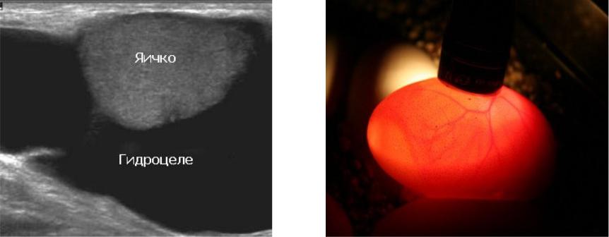 Гидроцеле яичка. Диафаноскопия при водянке яичка. Гидроцеле осумкованное. Водянка оболочек яичек (гидроцеле).