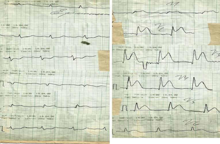 Инфаркт по экг фото