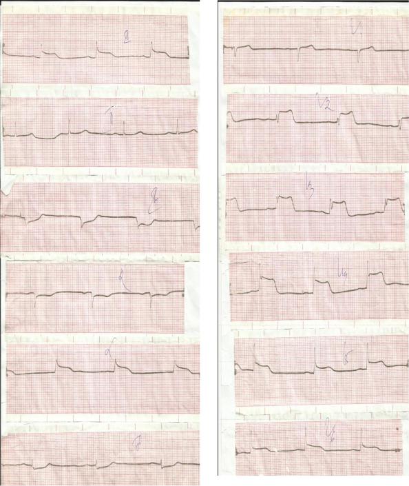 Кардиограмма при инфаркте миокарда фото сравнение с нормальной