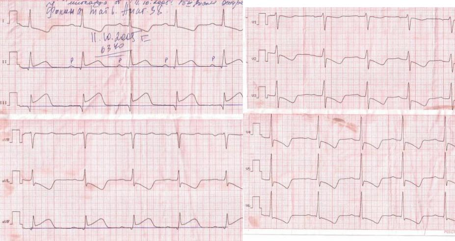 Фото кардиограмма при инфаркте миокарда