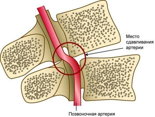 Сдавливание позвоночной артерии