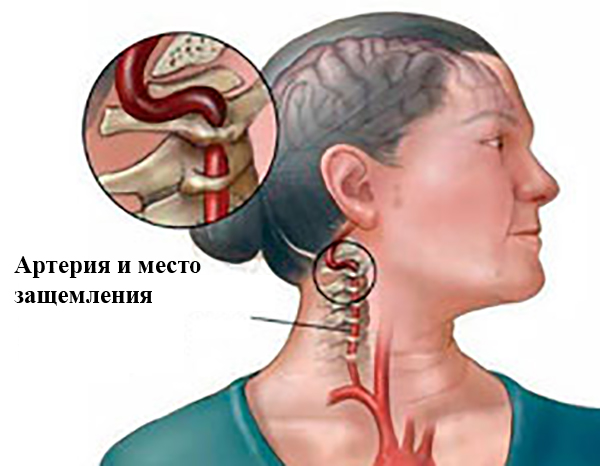 Артерия и защемление