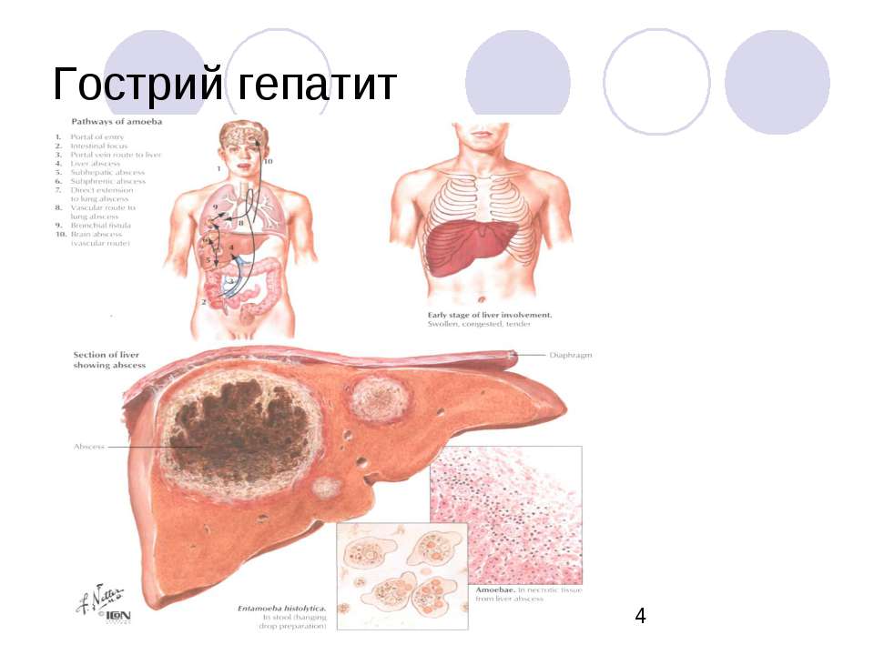 Первый симптом гепатита