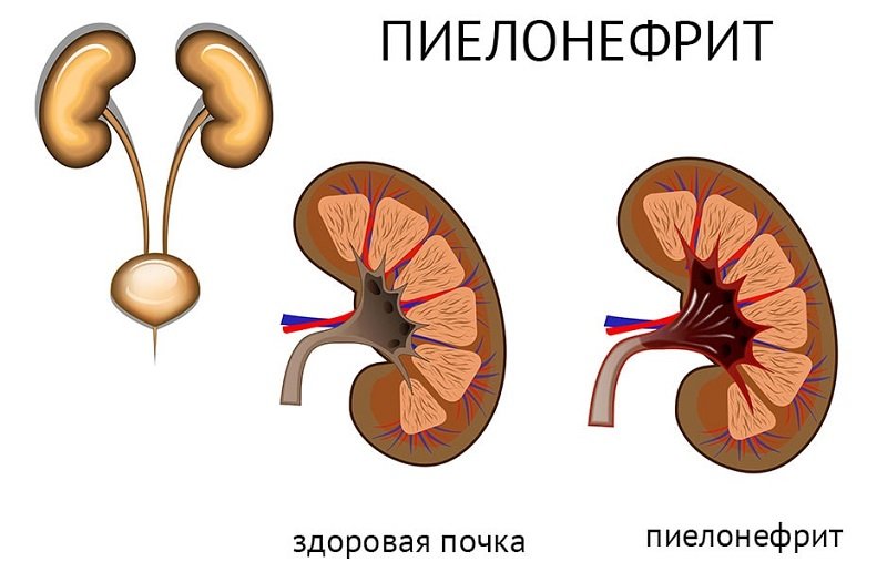 пиелонефрит