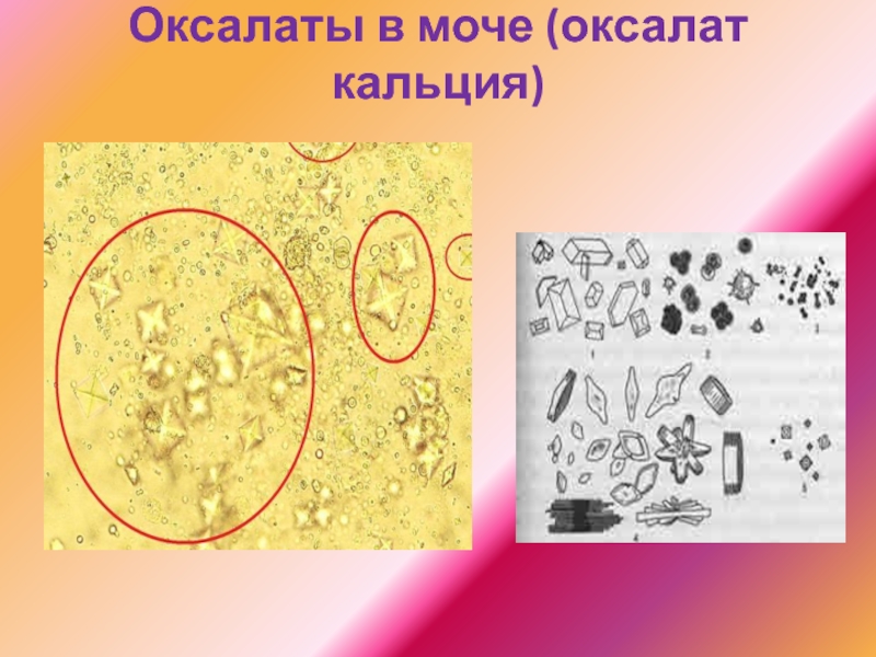 Оксалаты в моче это. Оксалаты кальция в моче. Оксалаты кальция в моче микроскопия. Кристаллы оксалаты в моче. Соли оксалаты кальция в моче.