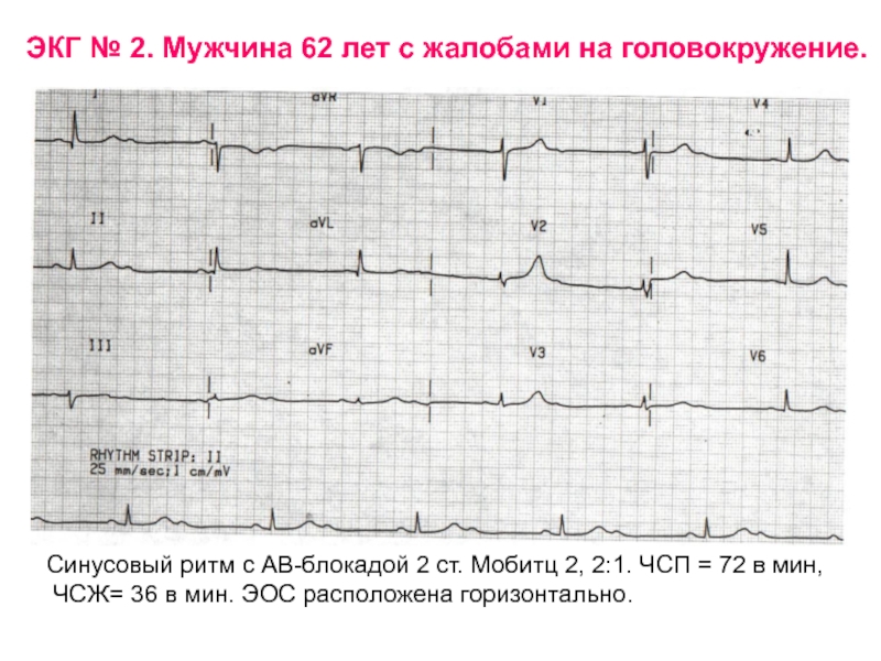 Синусовый ритм эос. АВ блокада 2 ст Мобитц 2 ЭКГ. ЭКГ при АВ блокада Мобиц 2. Атриовентрикулярная блокада Мобиц 1 ЭКГ. ЭКГ при АВ блокаде Мобитц 2.