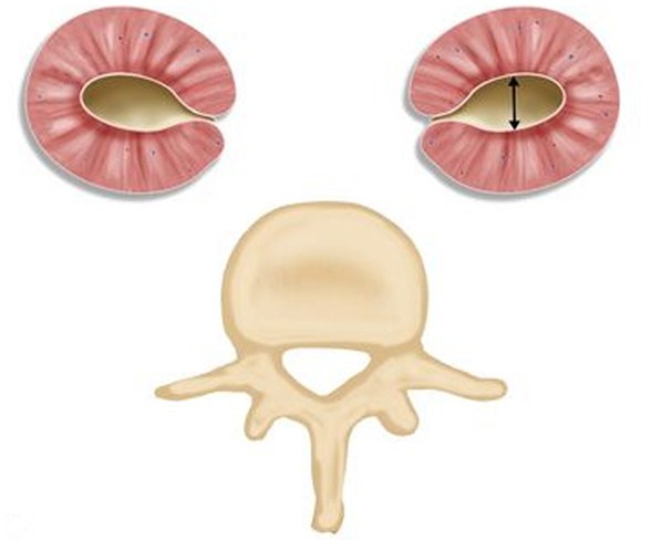 renal pyelectasis in the fetus