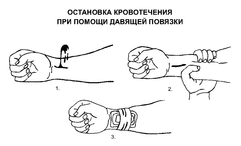 В случаях артериального кровотечения необходимо